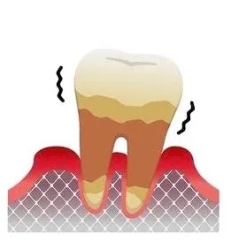 歯周炎(重度).jpg